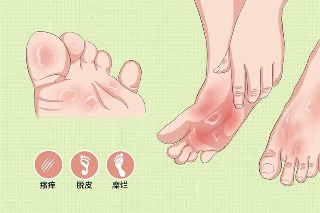 血糖高了,看脚就知道?脚部若有这4种变化,提醒你该降糖了
