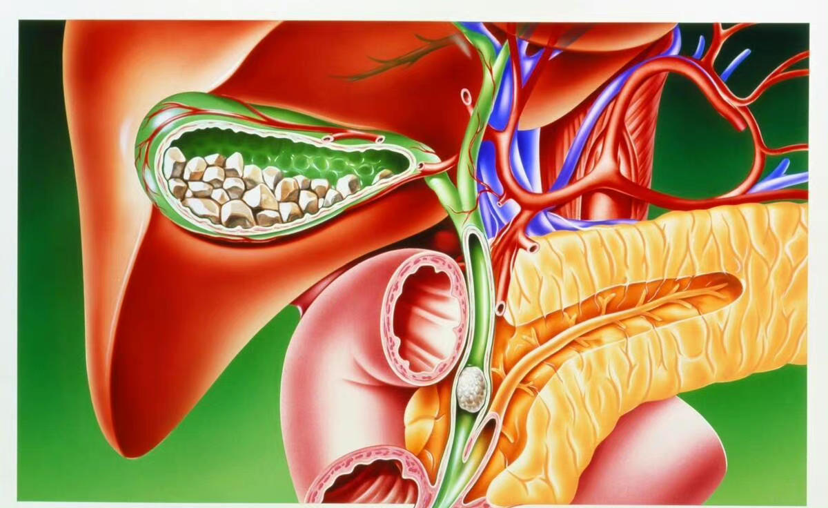 胆结石位置图图片