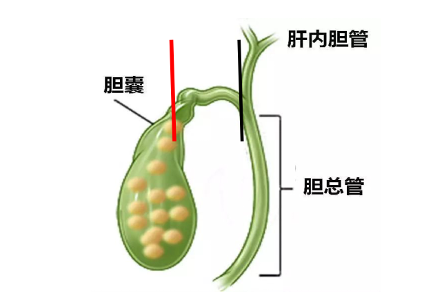 人没了胆囊,身体有什么变化?4种疾病或会找上门,不妨提前了解