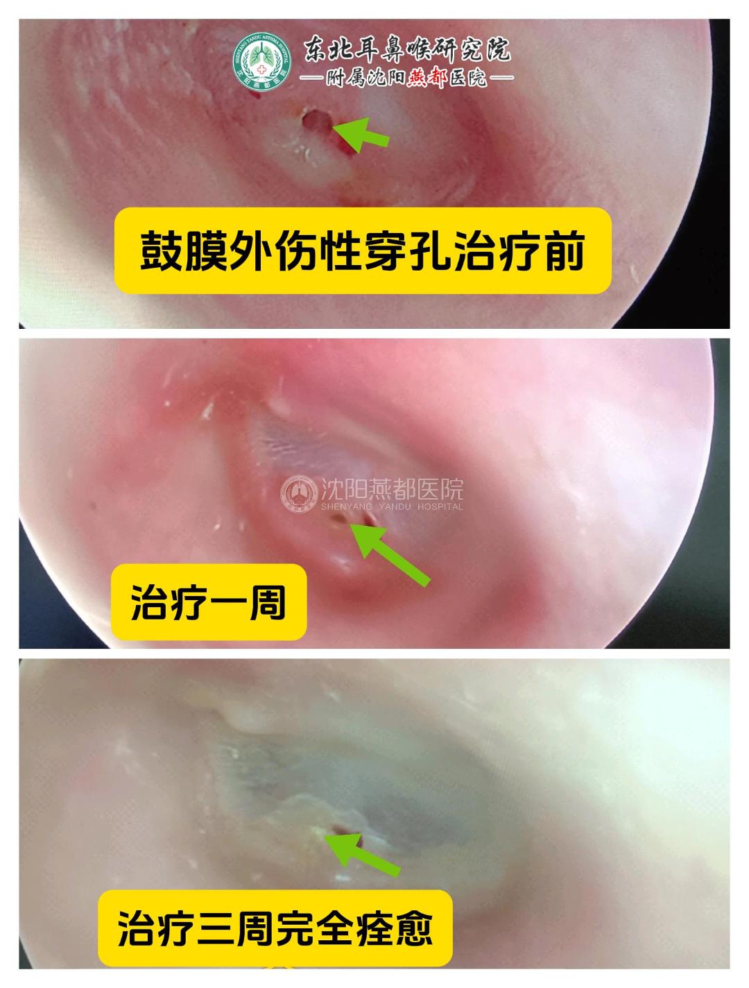 耳膜修复手术图片