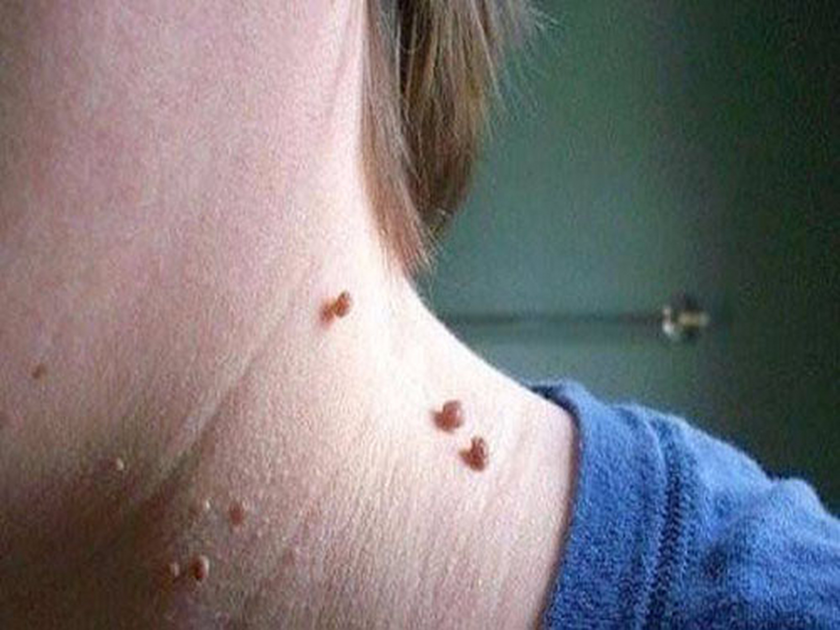 不同类型的疣,你认识几种