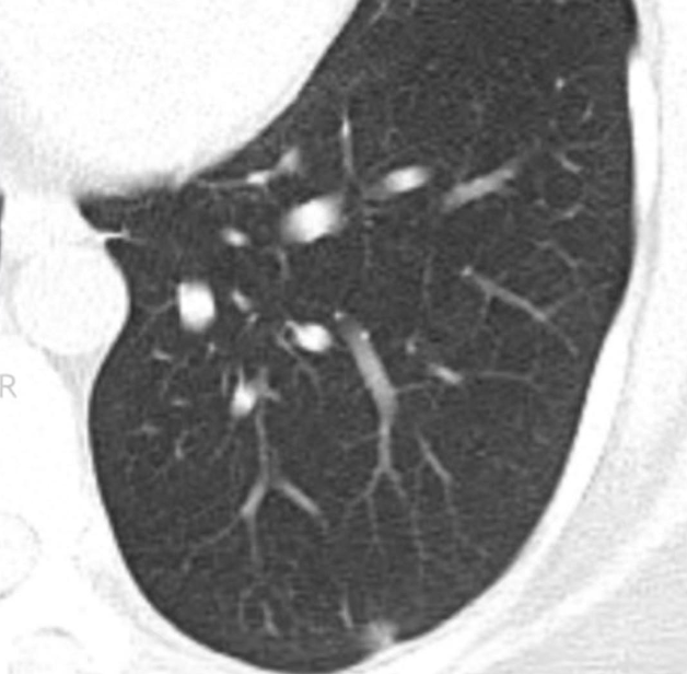 肺原位癌,微浸润癌,浸润癌,哪个术后能达到"治愈"?