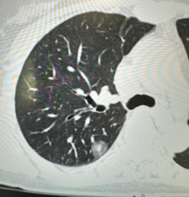 肺原位癌,微浸润癌,浸润癌,哪个术后能达到"治愈"?