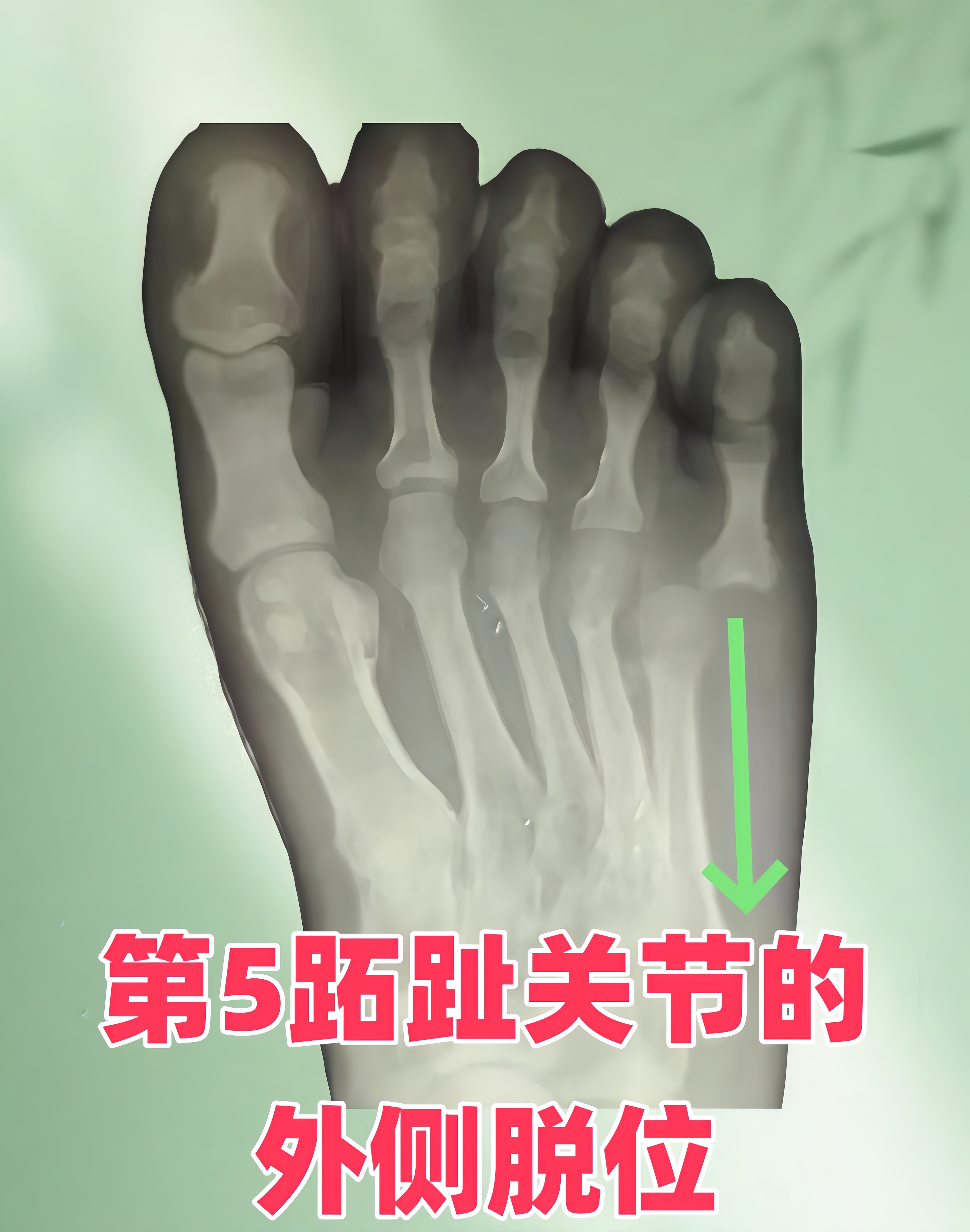 跖趾关节脱位是指跖骨头与近节趾骨构成的关节发生分离