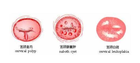 为什么子宫会长息肉和囊肿为什么在线