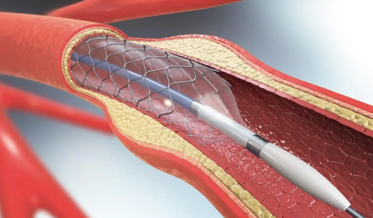 心脏支架位置图片