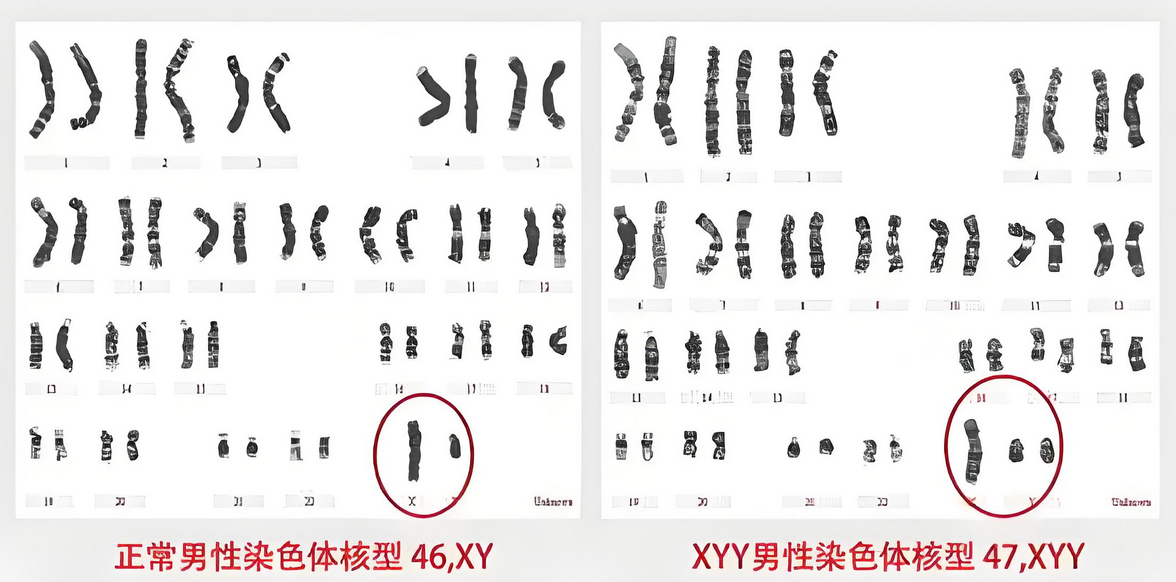 超雄综合征是天生坏种吗?产检出来生还是不生?