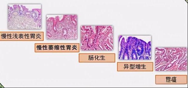 肠上皮化生是什么意思图片