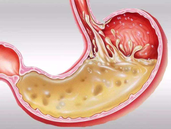 胃酸是怎么回事图片