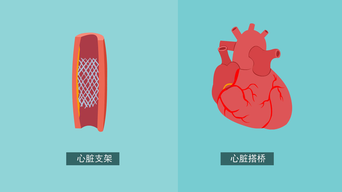 支架利大还是弊大?建议了解清楚