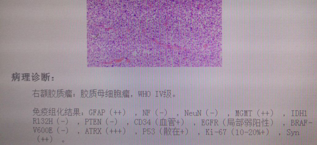 胶质瘤病理报告图片