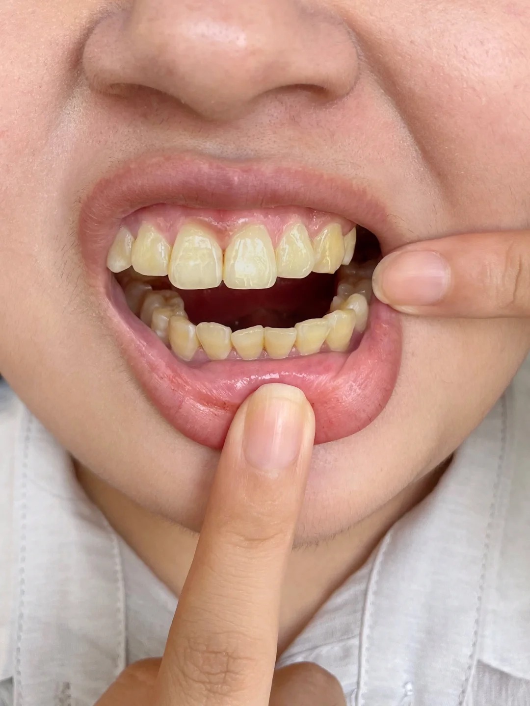 药店直接卖爆!(重度牙黄)