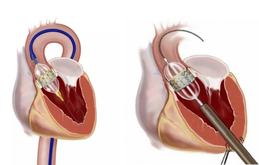生物瓣膜和机械瓣膜哪个比较好?