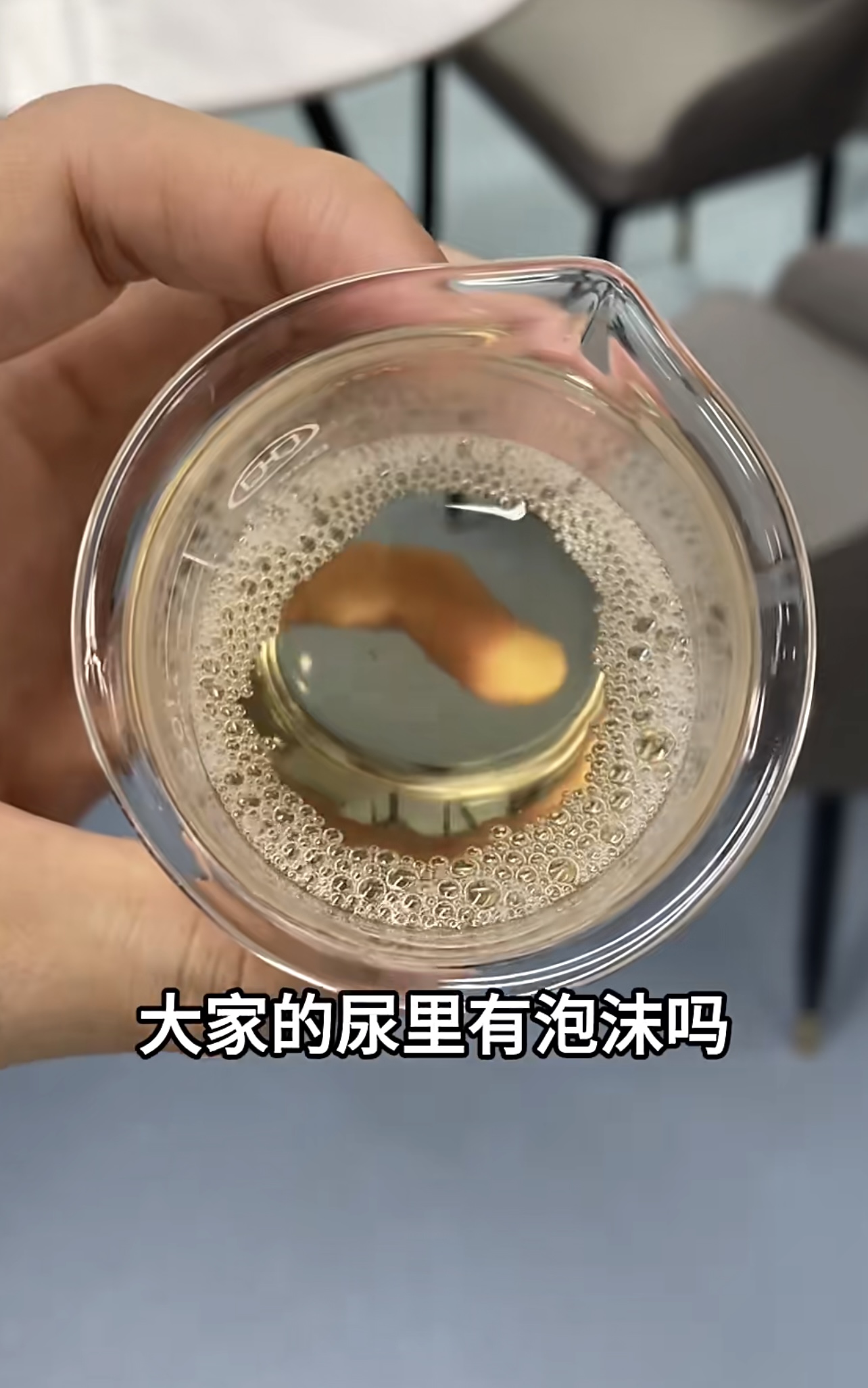 山西50岁徐先生尿蛋白高,医生:这种情况不用吃药,调整饮食就行