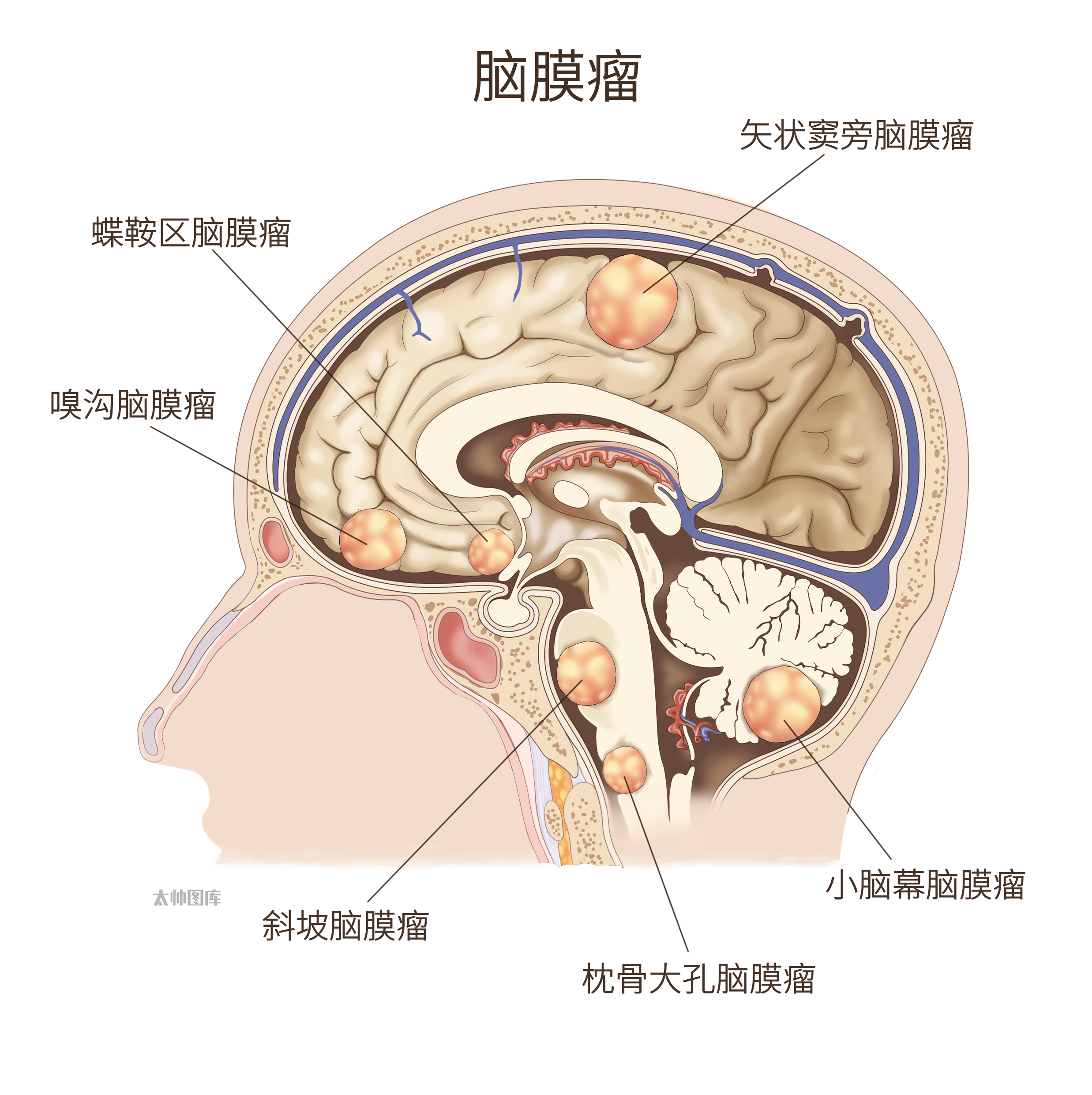 脑膜瘤的常见部位