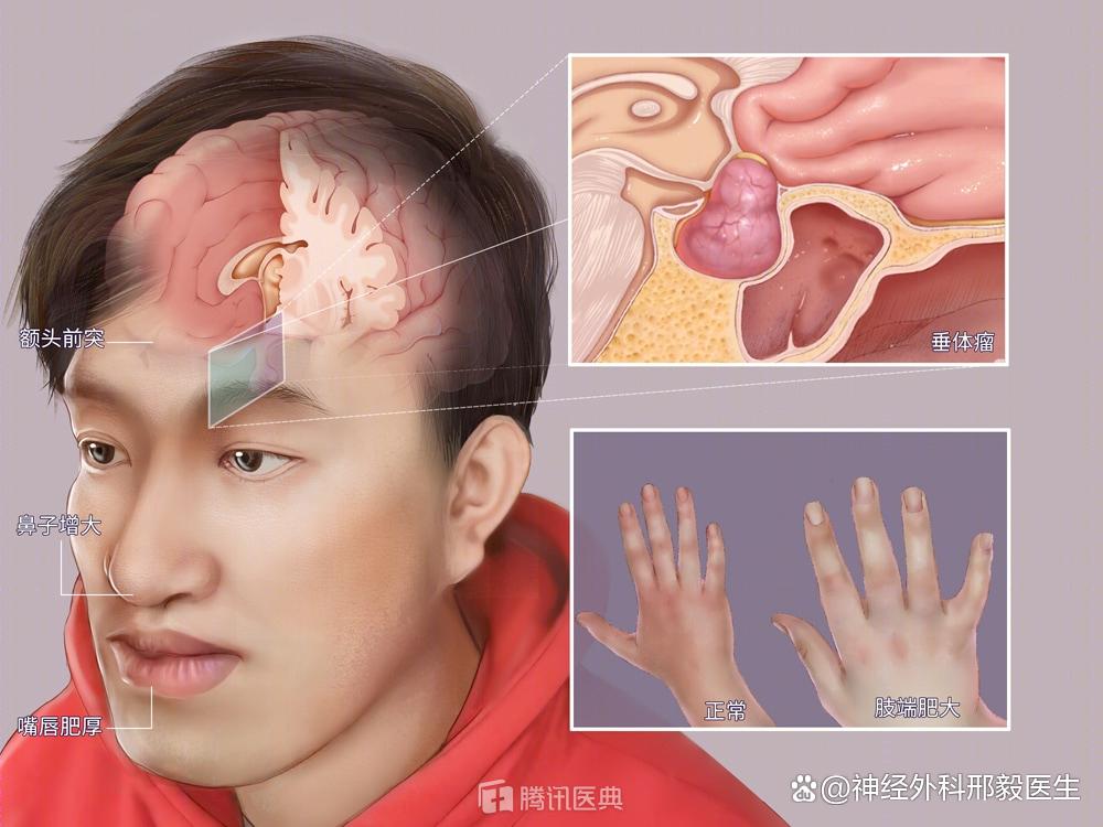 生长激素型垂体瘤手术能根治吗?