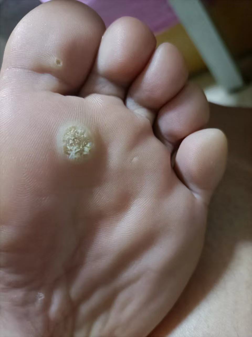 足部鸡眼如何处理