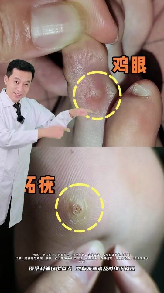 足部鸡眼如何处理
