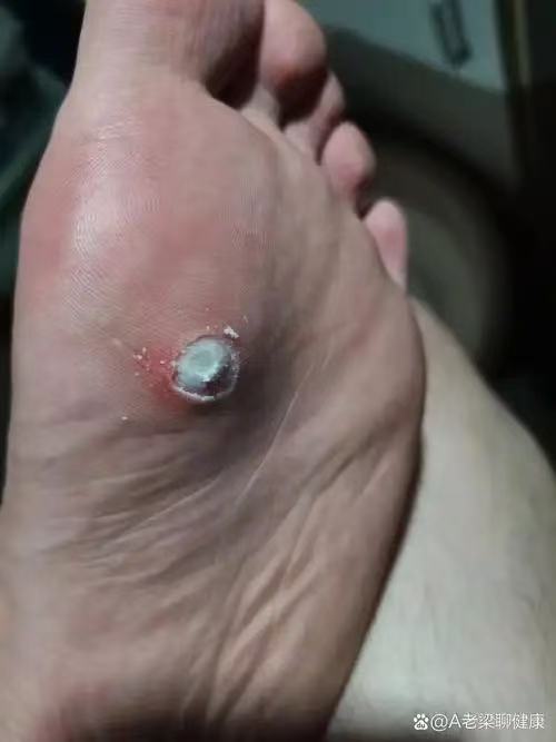 足部鸡眼如何处理