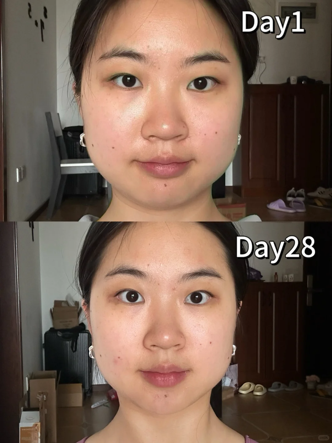 腮帮子大作战!拯救20 颜值,从战胜发腮开始!