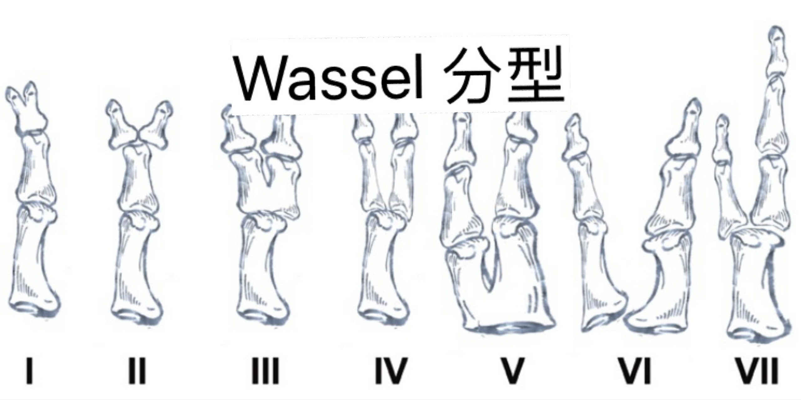 指蹼成形术图解图片