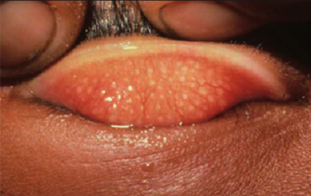 沙眼症状有哪些表现