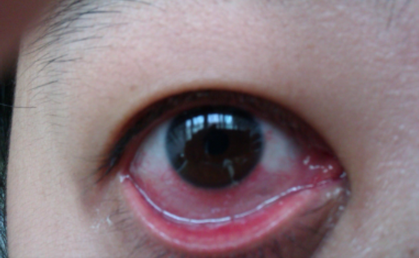 角膜炎治疗后视力可以恢复吗