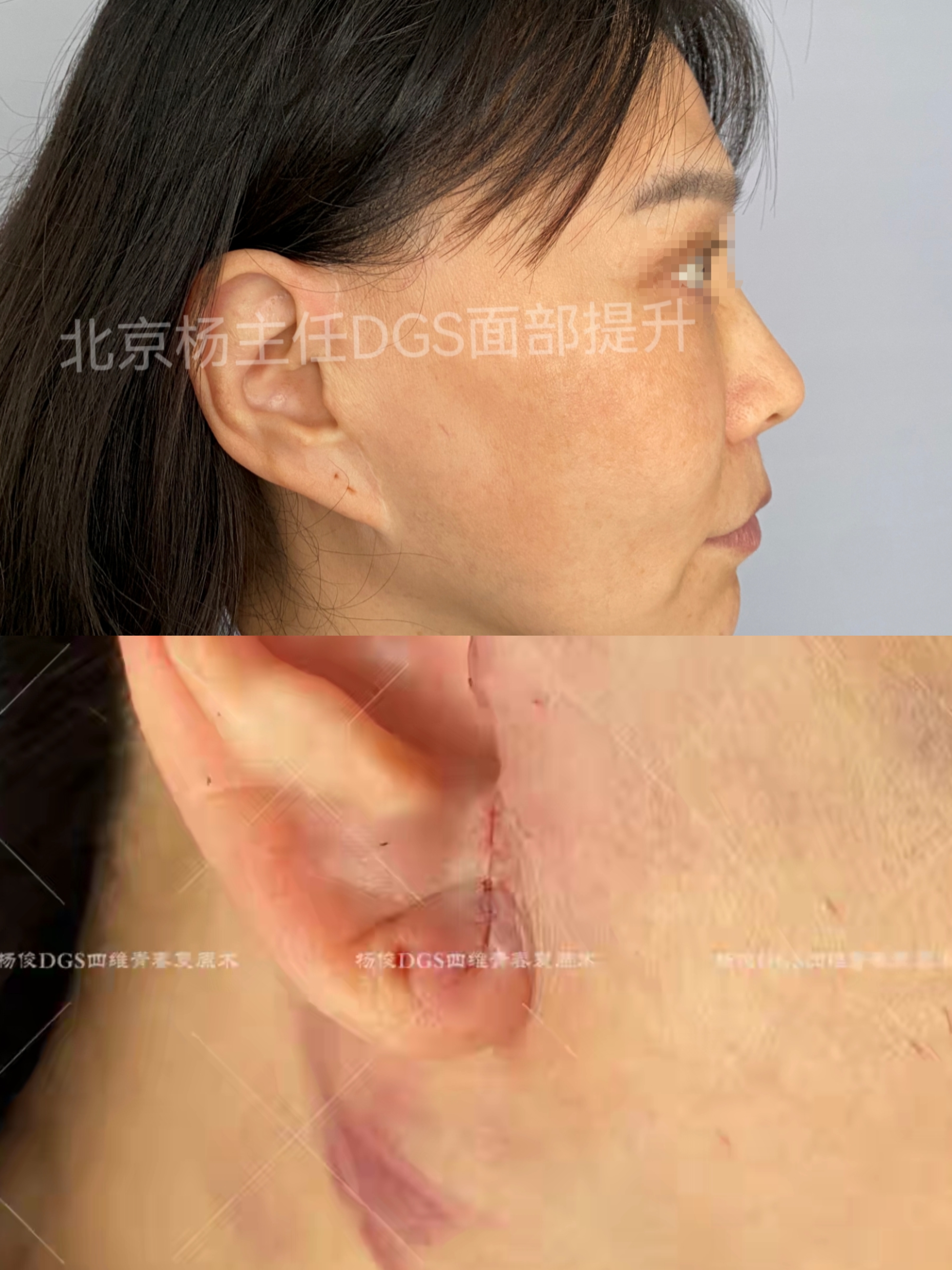 60岁女士第二次做拉皮,术后13天,终于成功上岸"修复了耳垂!