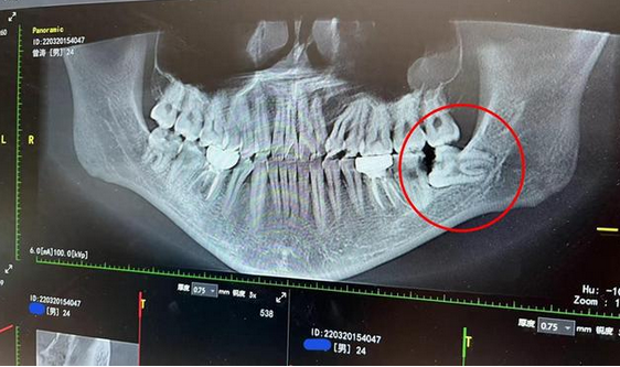 女子拔牙第3天嘴里散发腐臭味:干槽症的五大高危行为请自查!