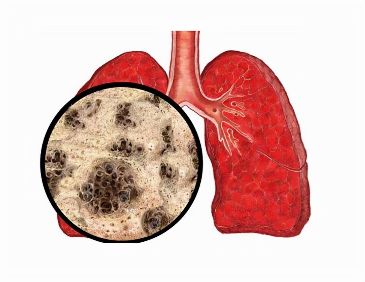 大的肺结节就一定是恶性的吗?