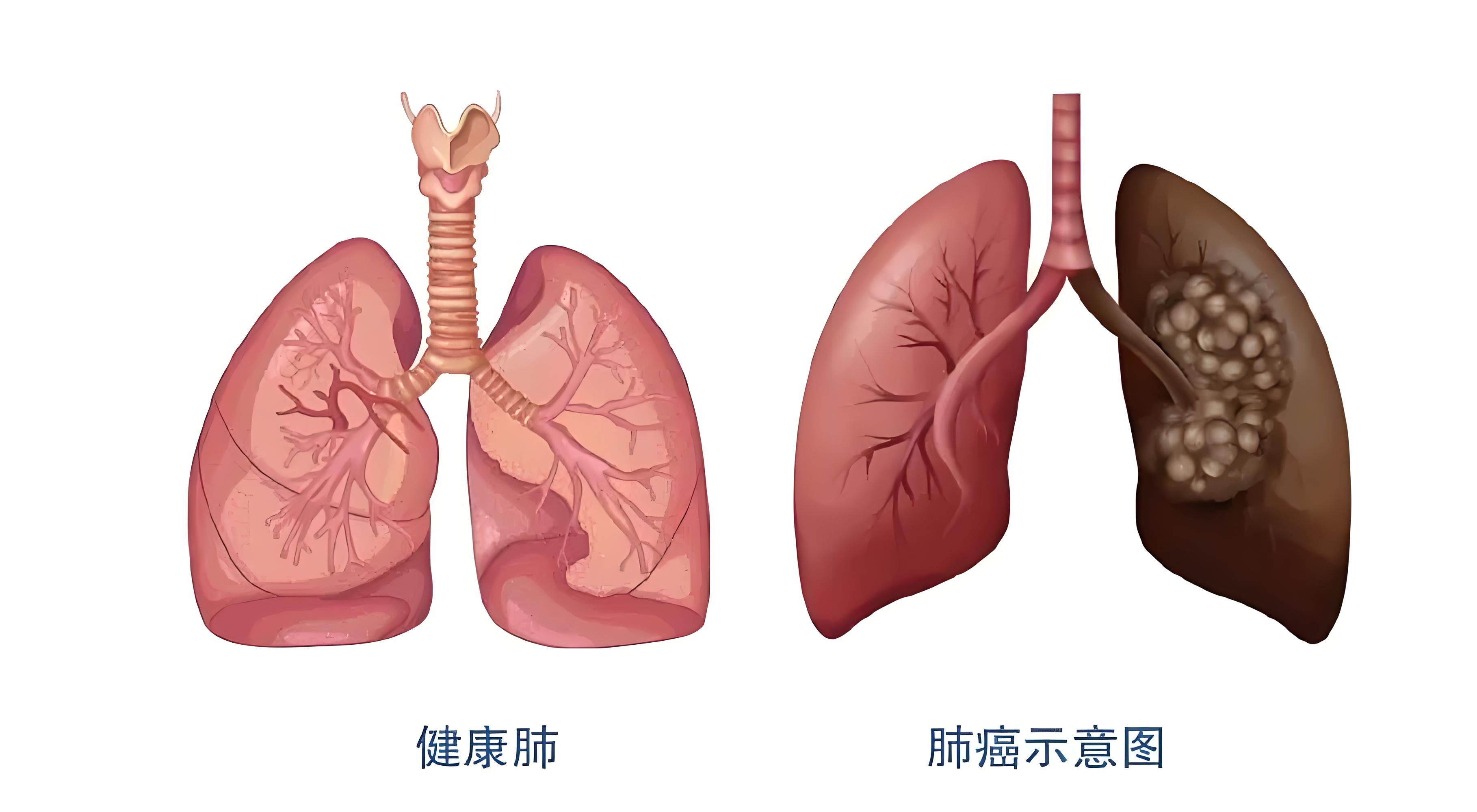 肺癌除了与吸烟有关