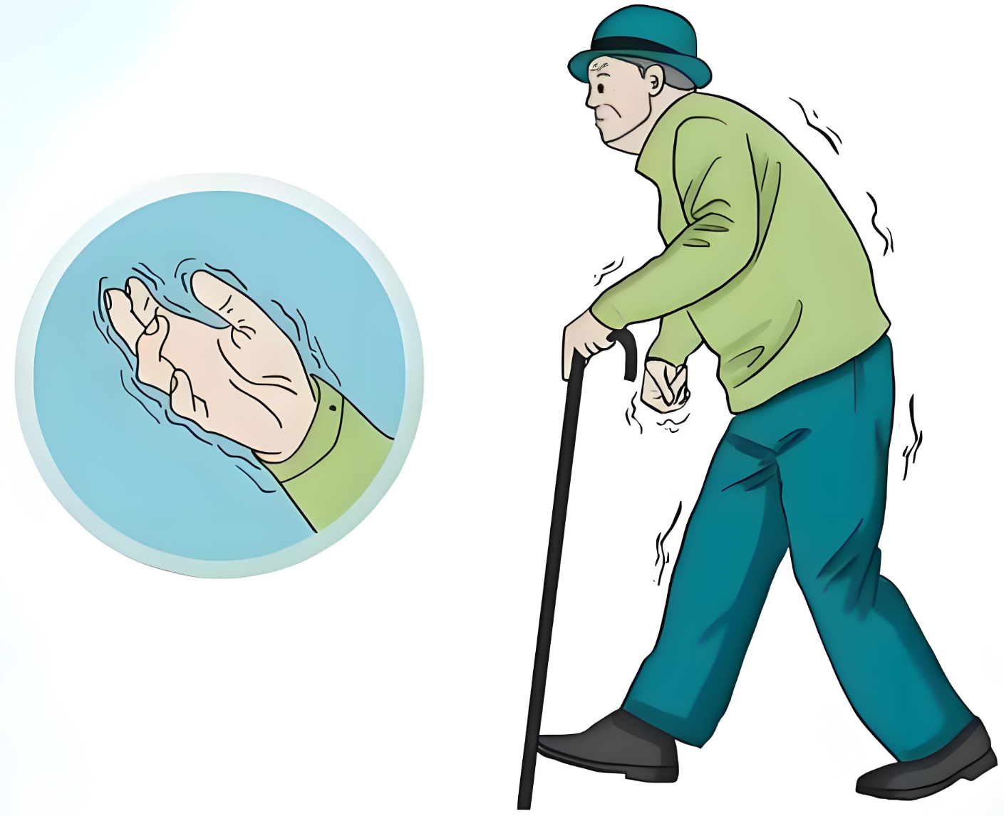 肢体不自主震颤,僵硬,行动越来越迟缓?