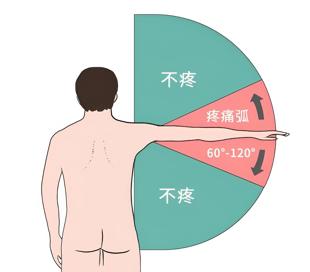 肩峰疼痛是什么原因图片