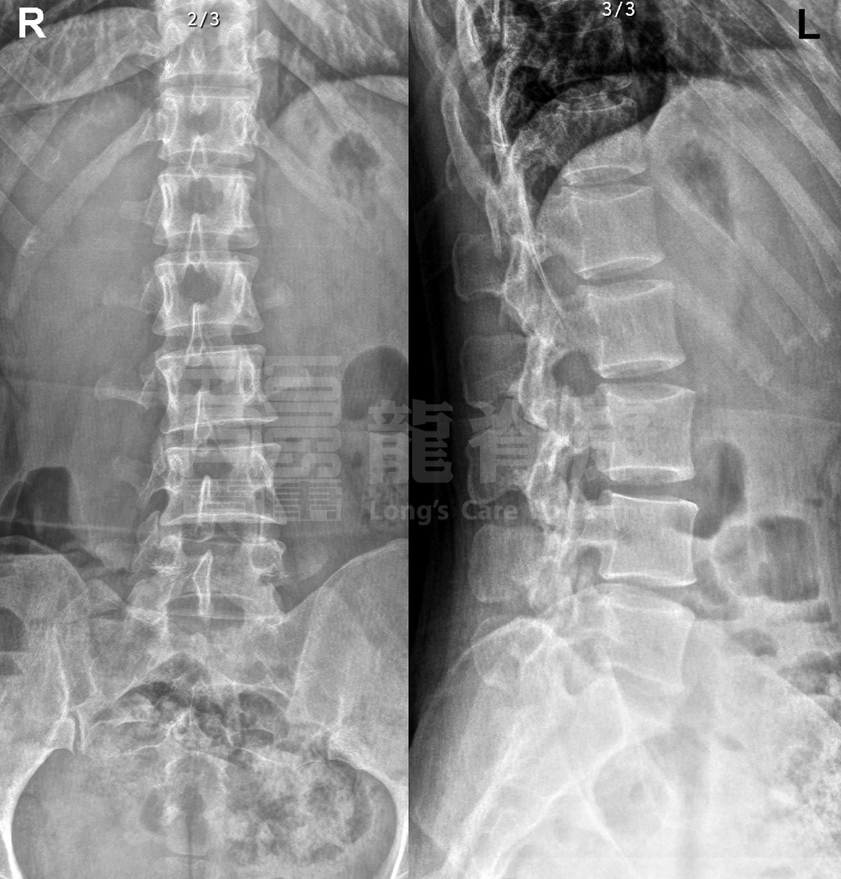 腰骶部伴下肢牵扯痛,骶髂关节错位,该如何康复治疗?