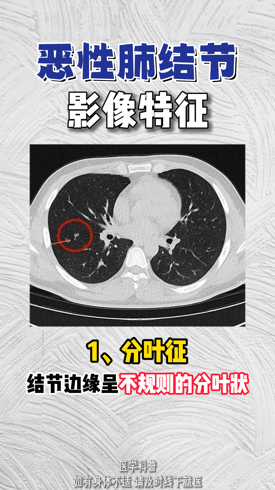 恶性肺结节的影像特征