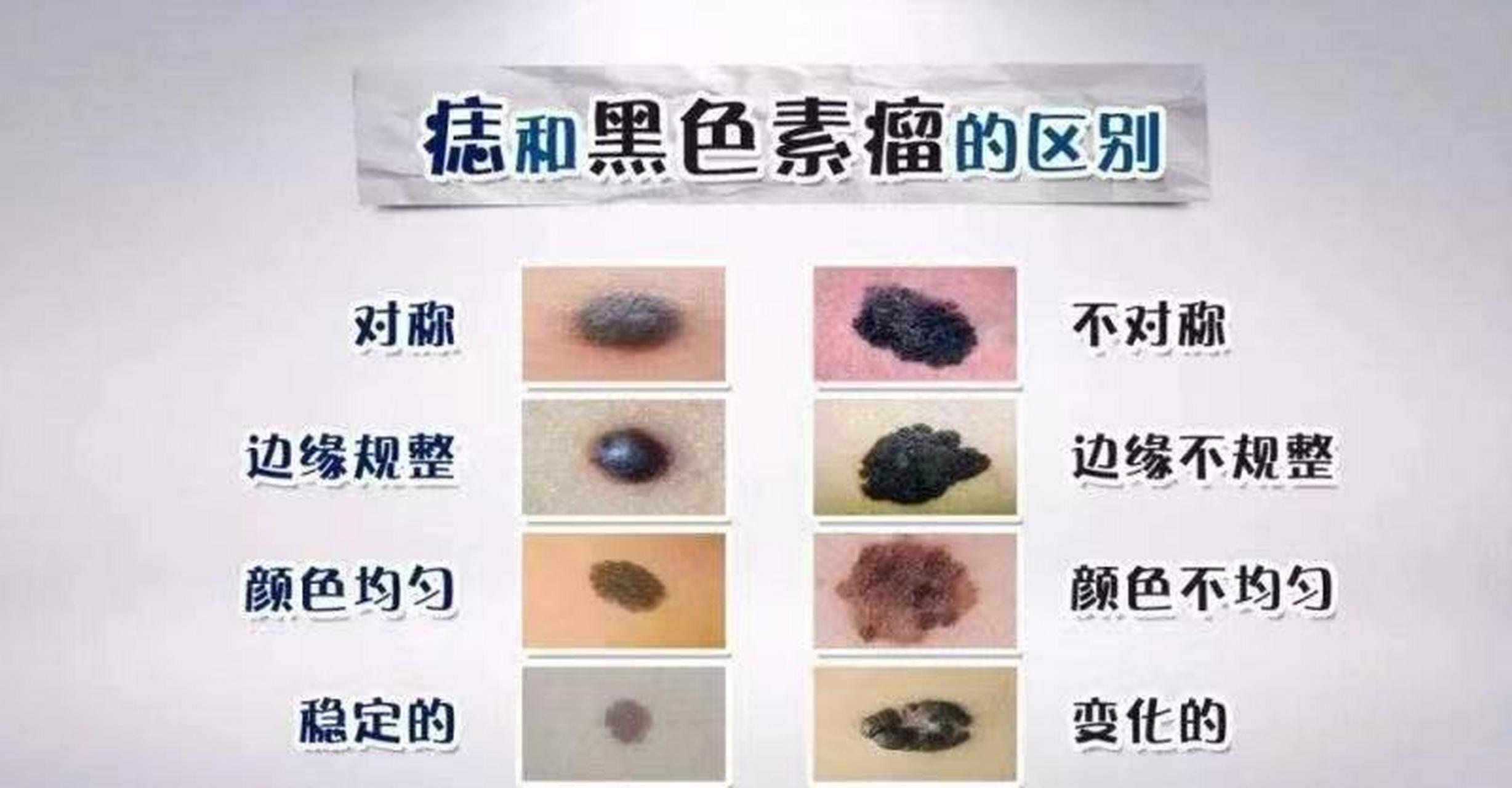 大多数痣,一般没关系,如出现以下特征,有可能是恶性,需要到医院就诊