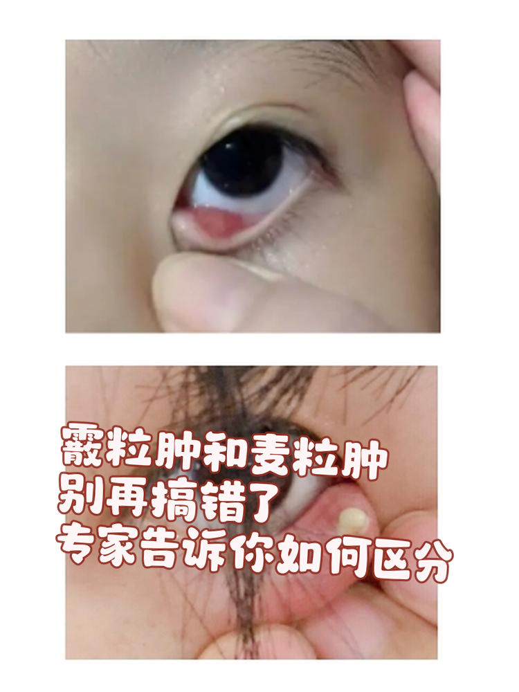 霰粒肿和麦粒肿都是眼科常见问题,但它们在表现和处理方式上却有