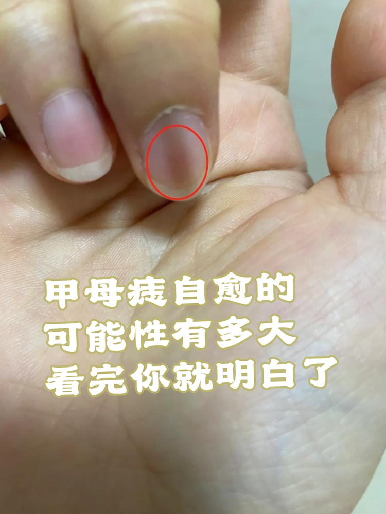 为什么会长痣