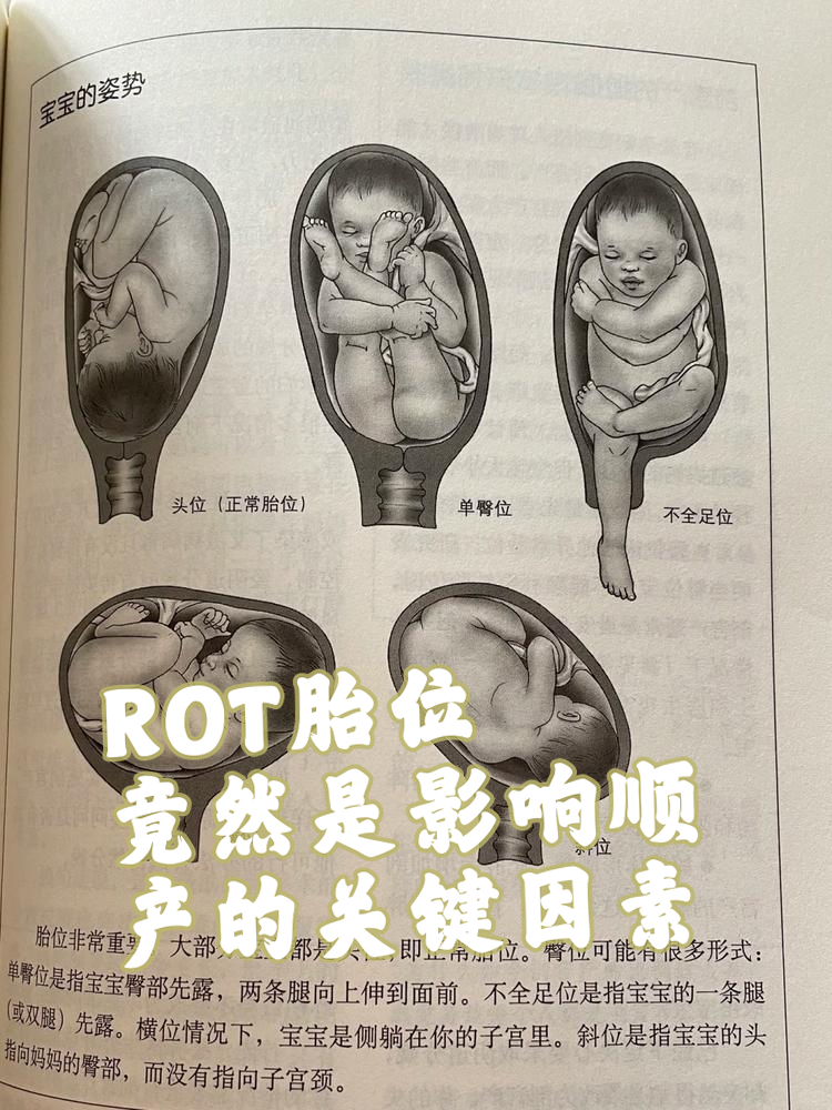 胎位对顺产的影响