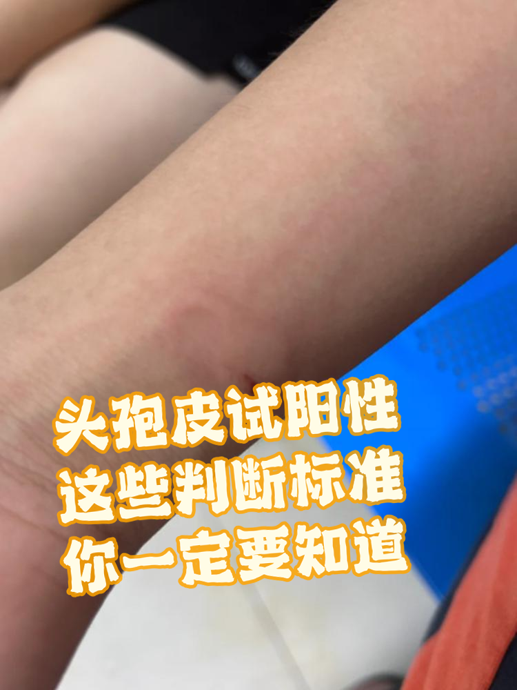 头孢类药物是我们日常生活中常用的抗生素之一,但皮试阳性可能困扰