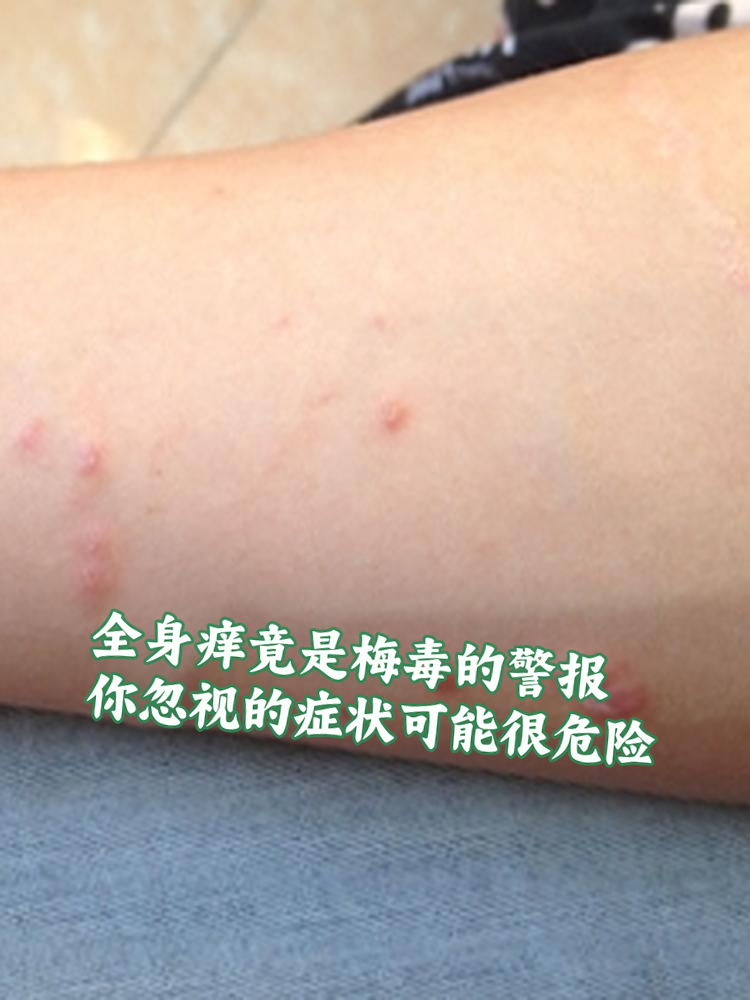 七年之痒的症状