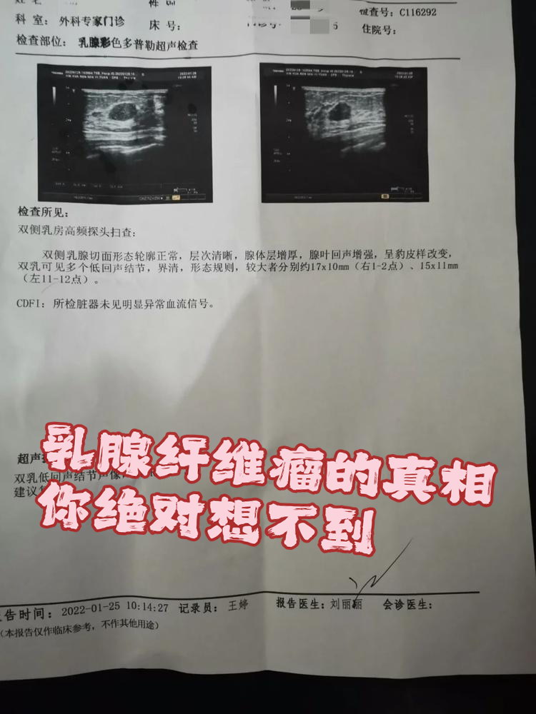 基本定义: 乳腺纤维瘤是一种良性肿瘤.它