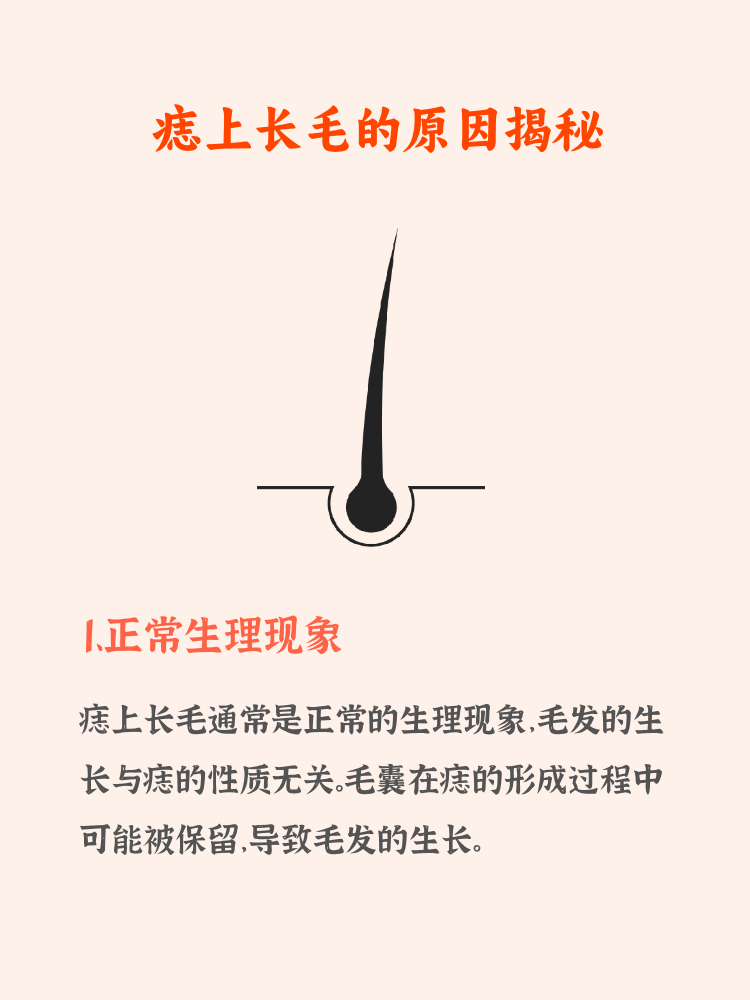 痣上长毛是为什么痣上长毛是什么情况痣长毛是好与坏痣上长毛好不好