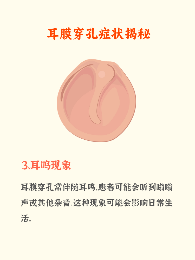 耳膜穿孔的症状你知道吗? 这些表现不可忽视!  1.