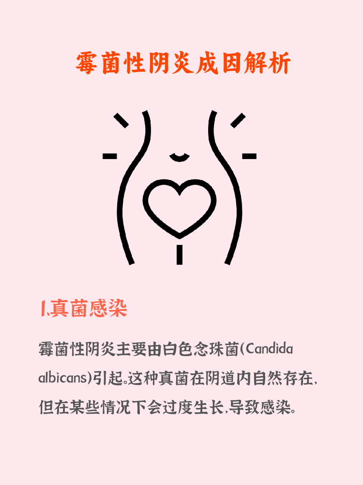 霉菌性阴炎由白色念珠菌引起.   2. 免疫系统下降易导致感染.   3.