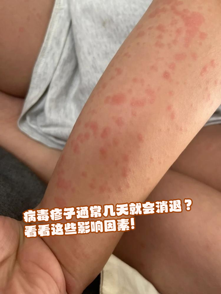 病毒疹子通常几天就会消退?看看这些影响因素!