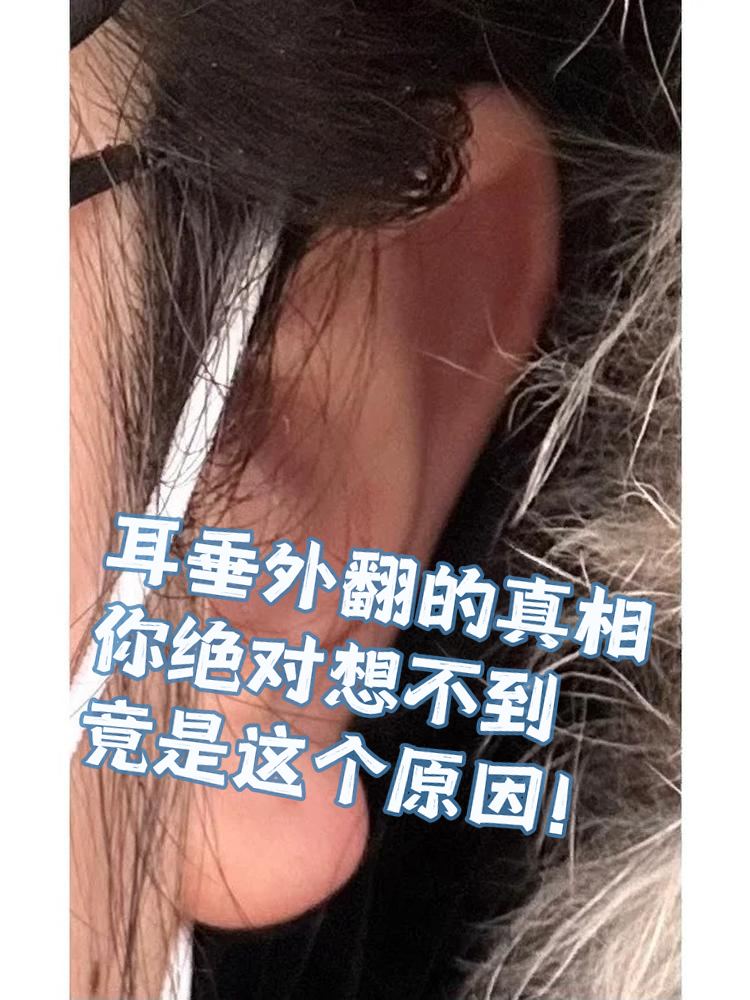 耳垂外翻是许多人可能都遇到过的小问题,但你知道吗?