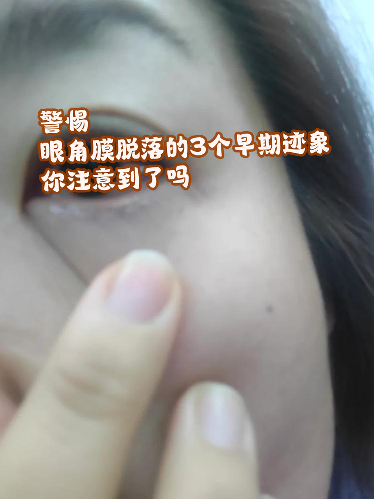 眼角膜脱落的3个早期迹象,你注意到了吗?