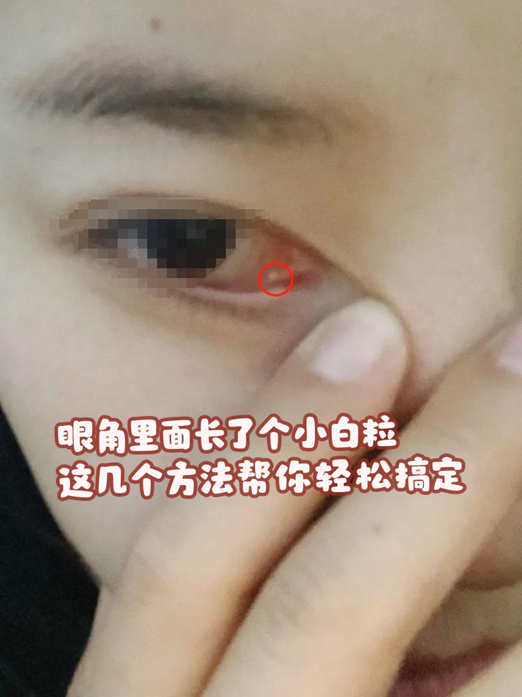疙瘩内眼角有肉坨怎么回事内眼角白色米粒图片眼角里面长了个小白粒