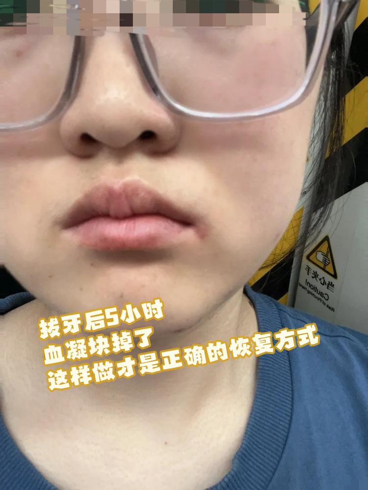 这样做才是正确的恢复方式!